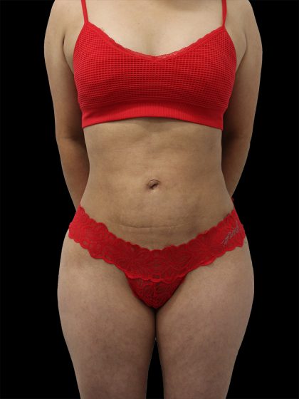 Liposuction Before & After Patient #2594