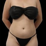 Liposuction Before & After Patient #2602