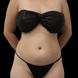 Liposuction Before & After Patient #2602
