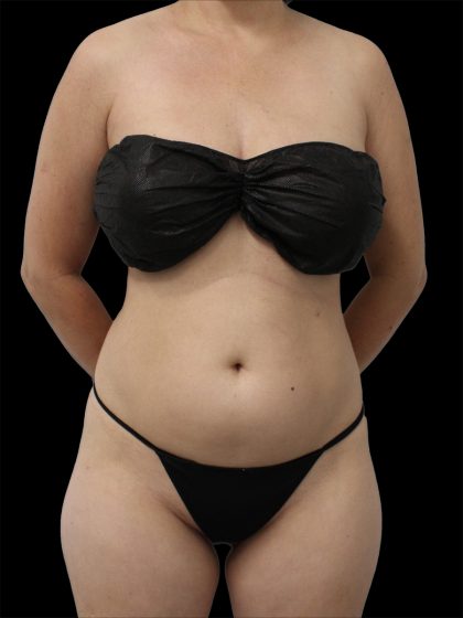 Liposuction Before & After Patient #2602