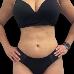 Liposuction Before & After Patient #2602
