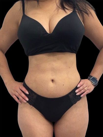Liposuction Before & After Patient #2602