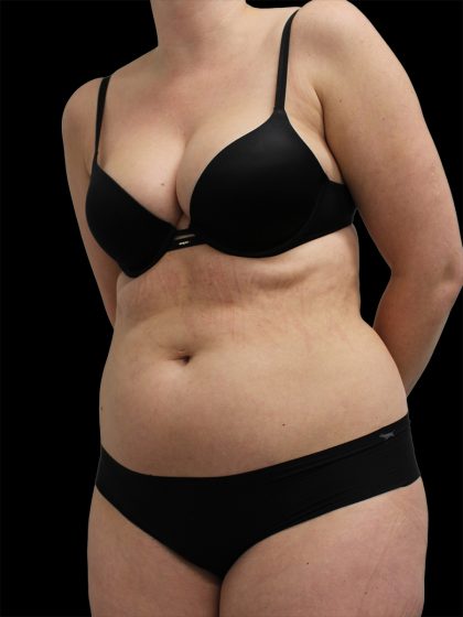 Liposuction Before & After Patient #2603