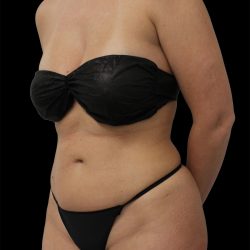 Liposuction Before & After Patient #2603
