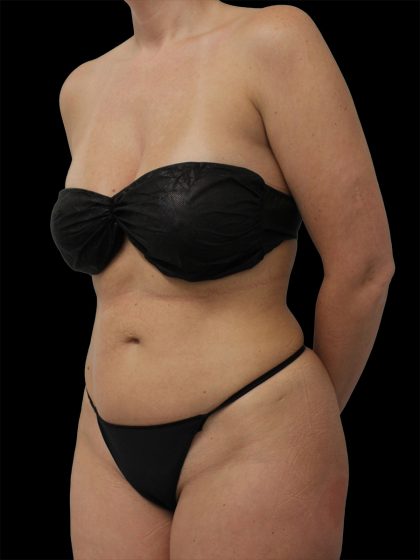 Liposuction Before & After Patient #2603