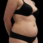 Liposuction Before & After Patient #2603