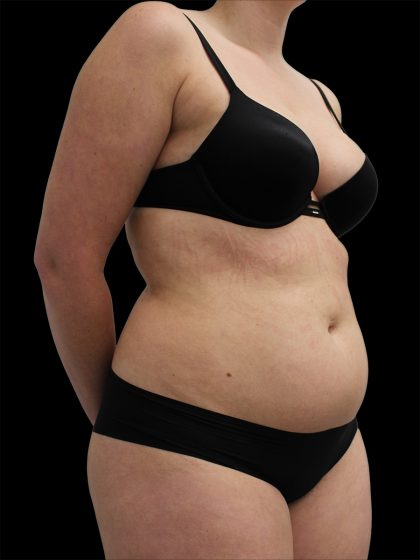 Liposuction Before & After Patient #2603