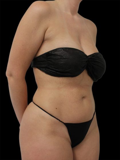 Liposuction Before & After Patient #2603