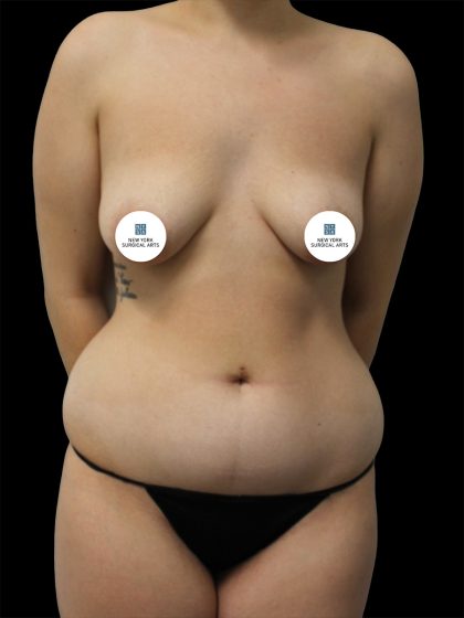 Liposuction Before & After Patient #2597