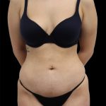Liposuction Before & After Patient #2597