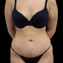 Liposuction Before & After Patient #2597