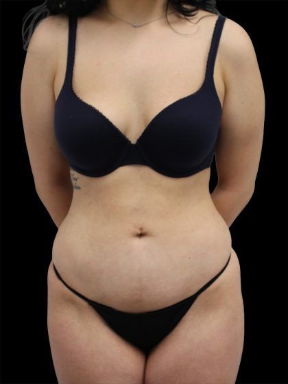 Liposuction Before & After Patient #2597