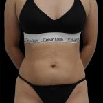 Liposuction Before & After Patient #2598