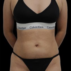 Liposuction Before & After Patient #2598
