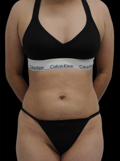 Liposuction Before & After Patient #2598
