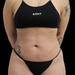 Liposuction Before & After Patient #2599
