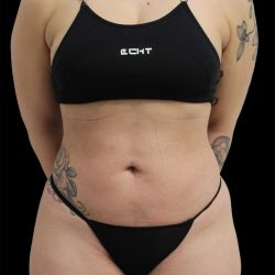 Liposuction Before & After Patient #2599