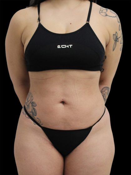 Liposuction Before & After Patient #2599