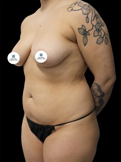 Liposuction Before & After Patient #2599