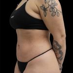 Liposuction Before & After Patient #2599