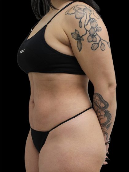 Liposuction Before & After Patient #2599