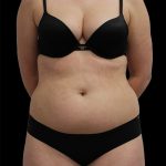 Liposuction Before & After Patient #2600