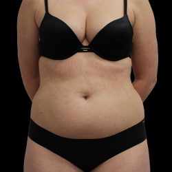 Liposuction Before & After Patient #2600