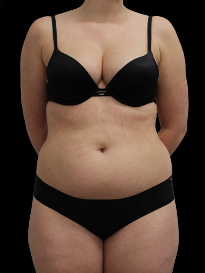 Liposuction Before & After Patient #2600