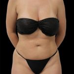 Liposuction Before & After Patient #2600