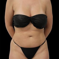 Liposuction Before & After Patient #2600