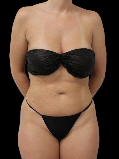 Liposuction Before & After Patient #2600