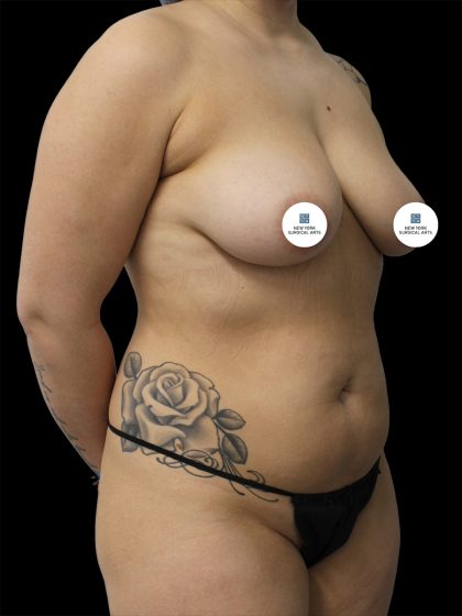 Liposuction Before & After Patient #2601