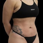 Liposuction Before & After Patient #2601