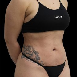 Liposuction Before & After Patient #2601