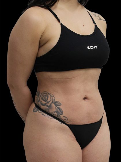 Liposuction Before & After Patient #2601