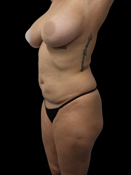Mommy Makeover Before & After Patient #2628