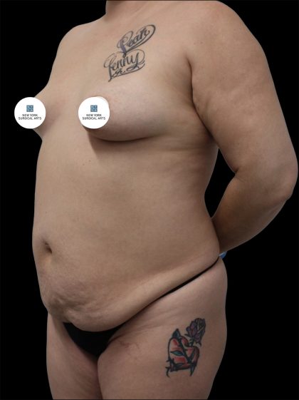 Mommy Makeover Before & After Patient #2637