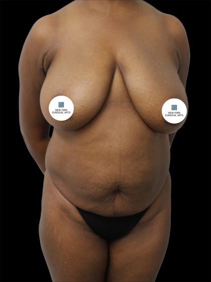 Mommy Makeover Before & After Patient #2638