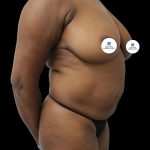 Mommy Makeover Before & After Patient #2638