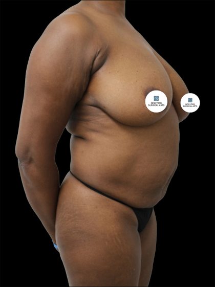 Mommy Makeover Before & After Patient #2638