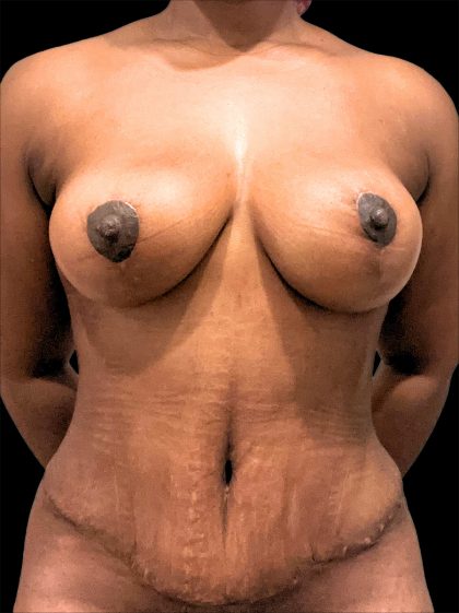Mommy Makeover Before & After Patient #2639