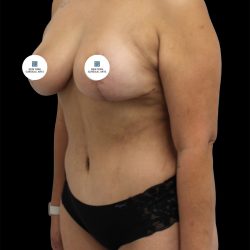 Mommy Makeover Before & After Patient #2640