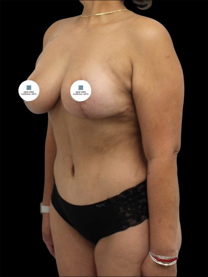 Mommy Makeover Before & After Patient #2640