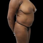 Mommy Makeover Before & After Patient #2629