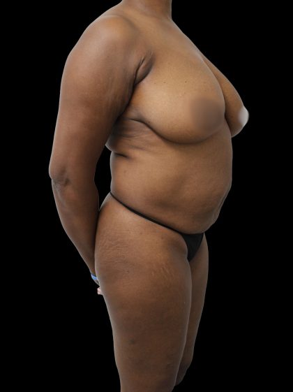 Mommy Makeover Before & After Patient #2629