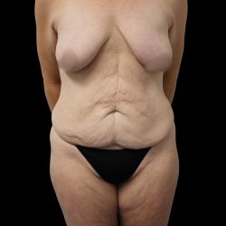 Mommy Makeover Before & After Patient #2630