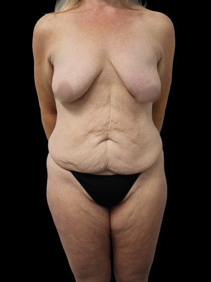 Mommy Makeover Before & After Patient #2630