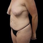 Mommy Makeover Before & After Patient #2630