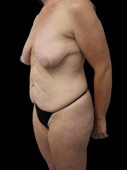 Mommy Makeover Before & After Patient #2630