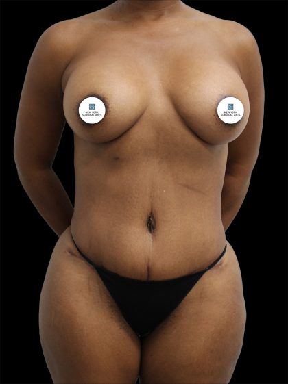 Mommy Makeover Before & After Patient #2631